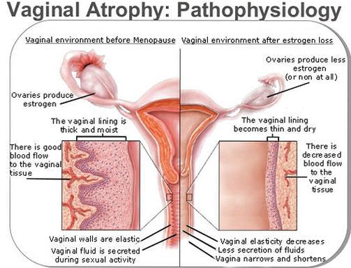 Vaginl Atrophy After Menopause