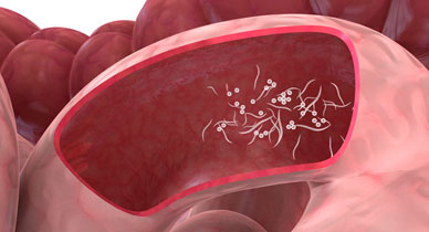 388x210 Pinworm_Infection