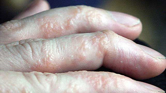 642x361_GALLERY_3 What_Are_the_Different_Types_of_Eczema