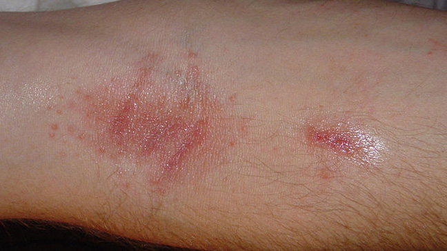 Contact_dermatitis_poison_ivy_3