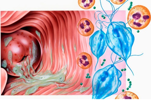 Trichomoniasis 4