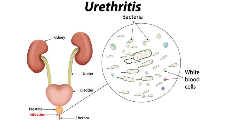 Urethritis