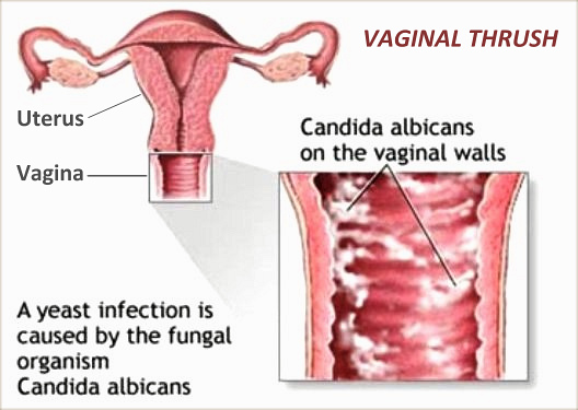 Vaginal Thrush