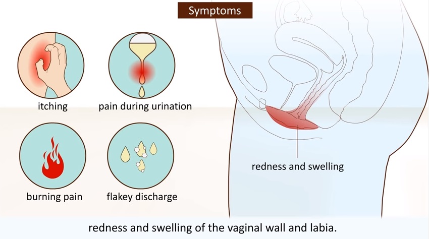 Vaginal Yeast Infection Symptoms