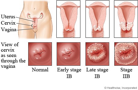 What Are Genital Warts
