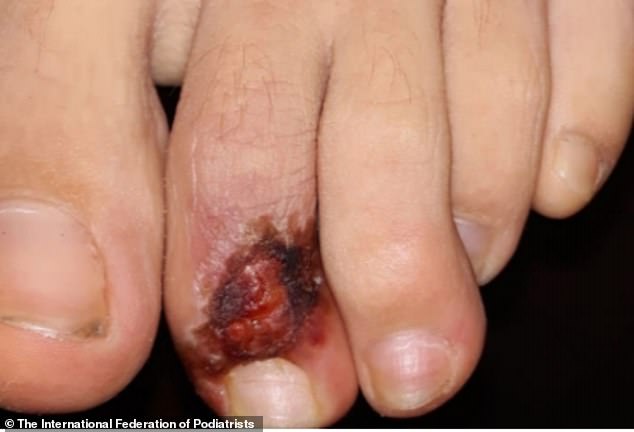 27181964 8217901 The_teenager_in_Italy_saw_his_lesions_initially_thought_to_be_ca A 75_1586878217716