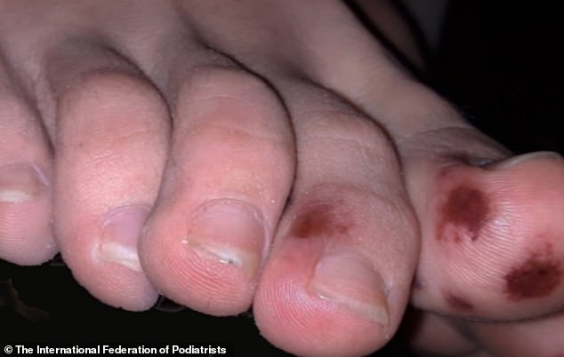 27181966 8217901 Bruising_and_lesions_on_the_feet_could_be_a_sign_of_coronavirus_ A 74_1586878212817
