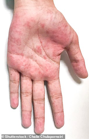 27696120 8260399 Toxic_shock_syndrome_may_also_cause_rashes_but_it_s_not_clear_if A 1_1587998224955
