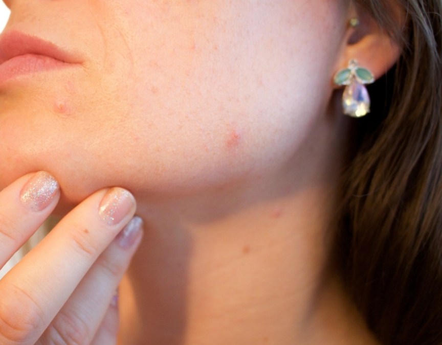 Bestkoreanskincareproductsforoilyacneproneskinkoreanskincareacneingredients