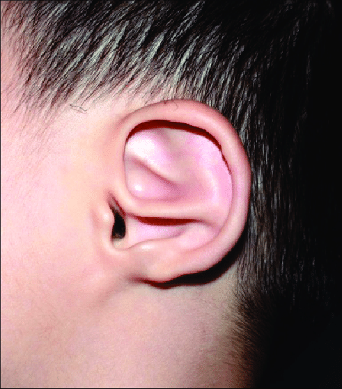 A 4 Year Old Male Patient With Congenital Small Earlobe And Antihelical Deformity On The