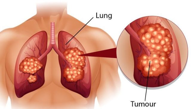 Lung Cancer