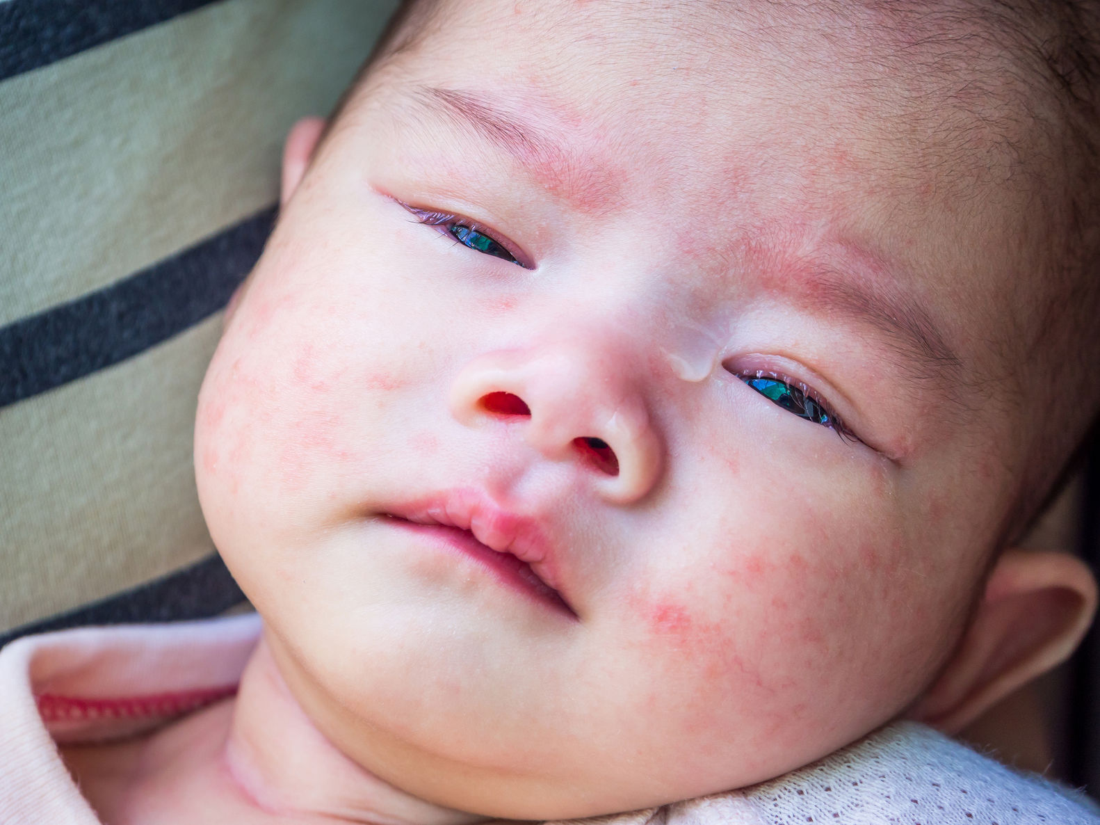 82147608 Newborn Baby With Dermatitis Allergy On Face