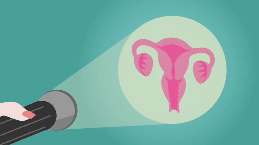 Mich CervicalCancer