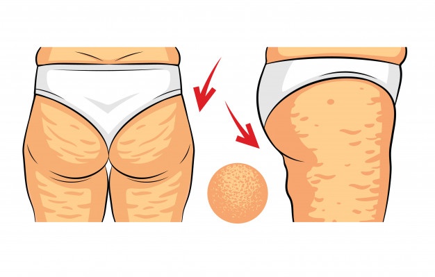 Color Vector Illustration Cellulite Problem Female Hips Rear View Side View Fat Deposits Female Buttocks Hip With Orange Peel Macro View_156811 100