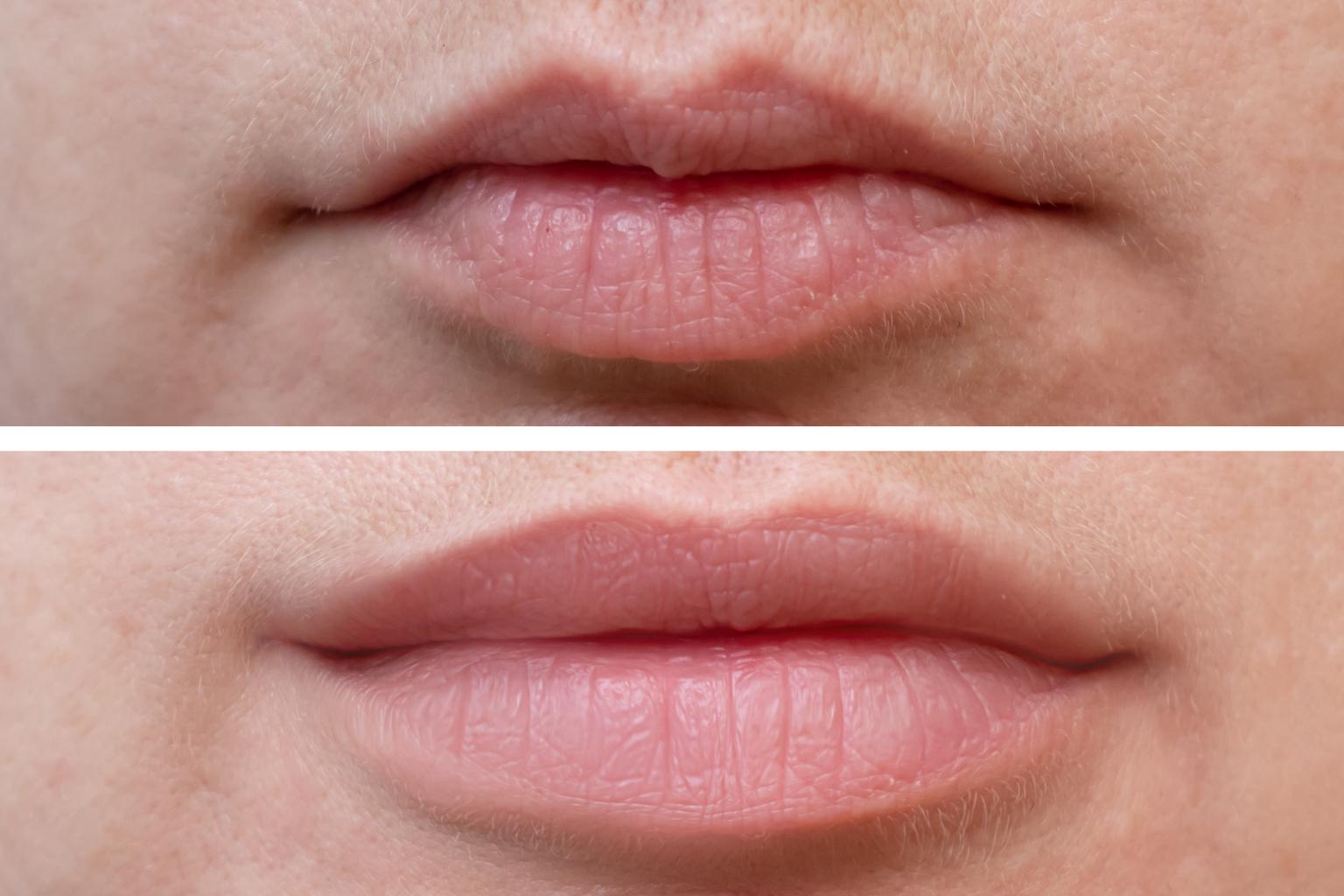 Lip Fillers Before After