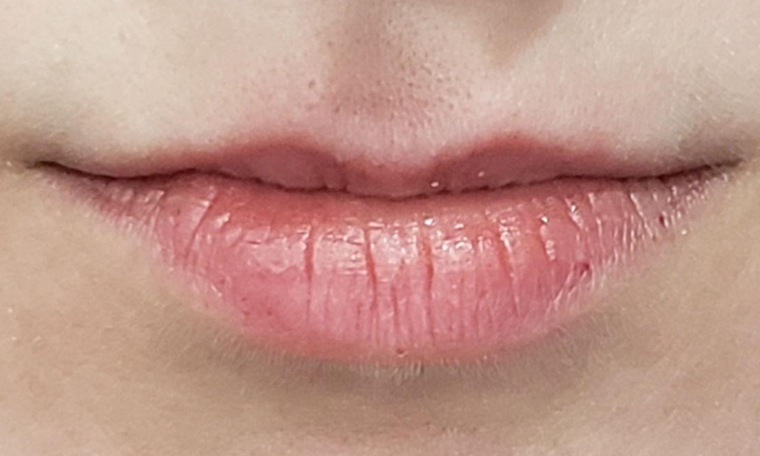Before Juvederm Used To Plump Upper Lip