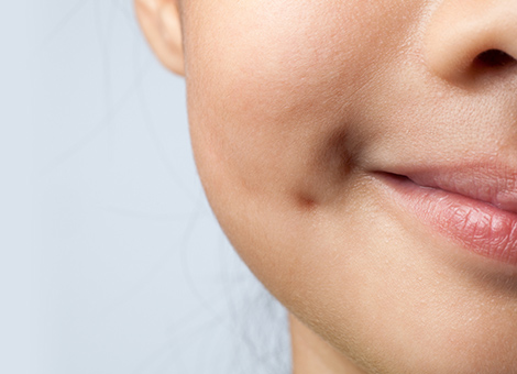 DIMPLE CREATION