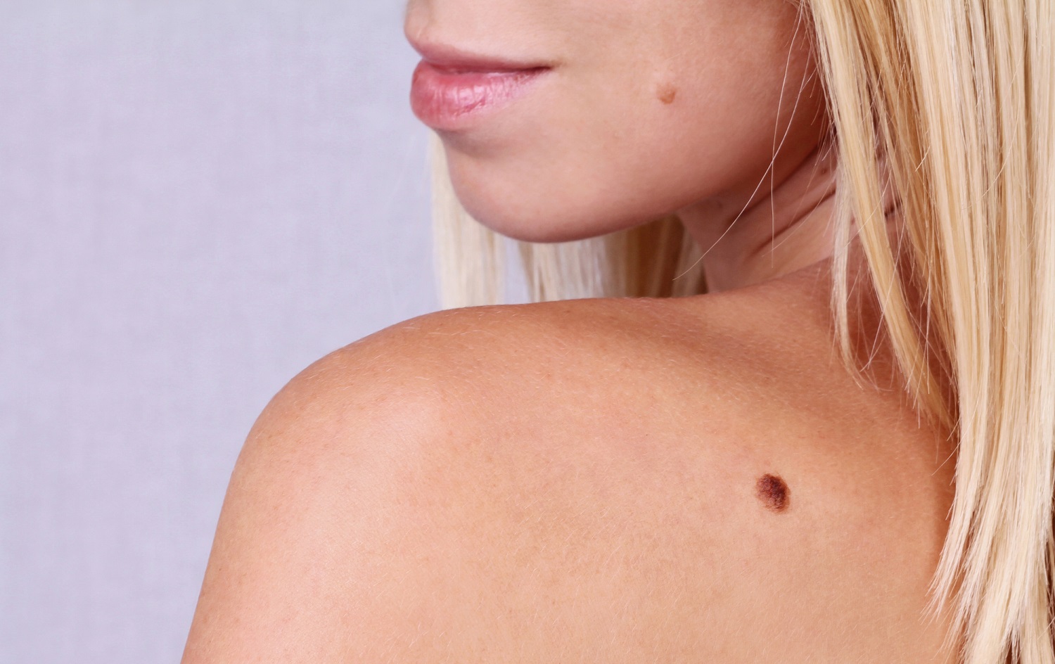 Chemical Peels And Moles