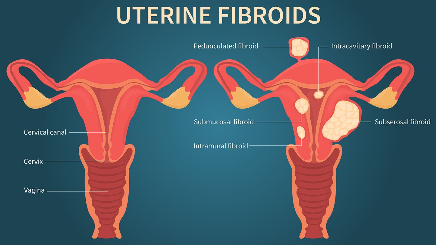 Cs The Link Between Uterine Fibroids And Heavy Menstrual Bleeding 1440x810