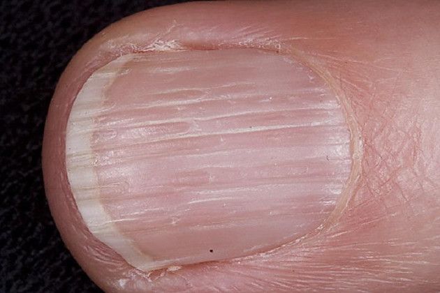 Nail5