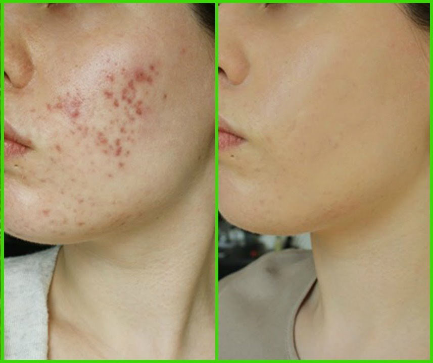 Acne