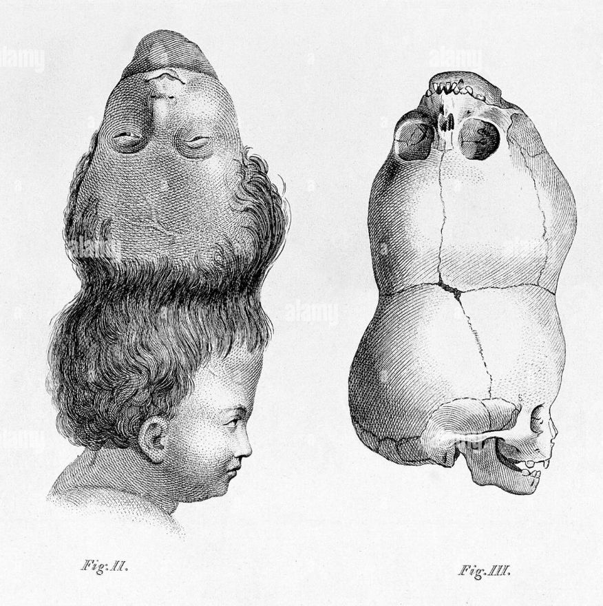 Two Headed Boy 1