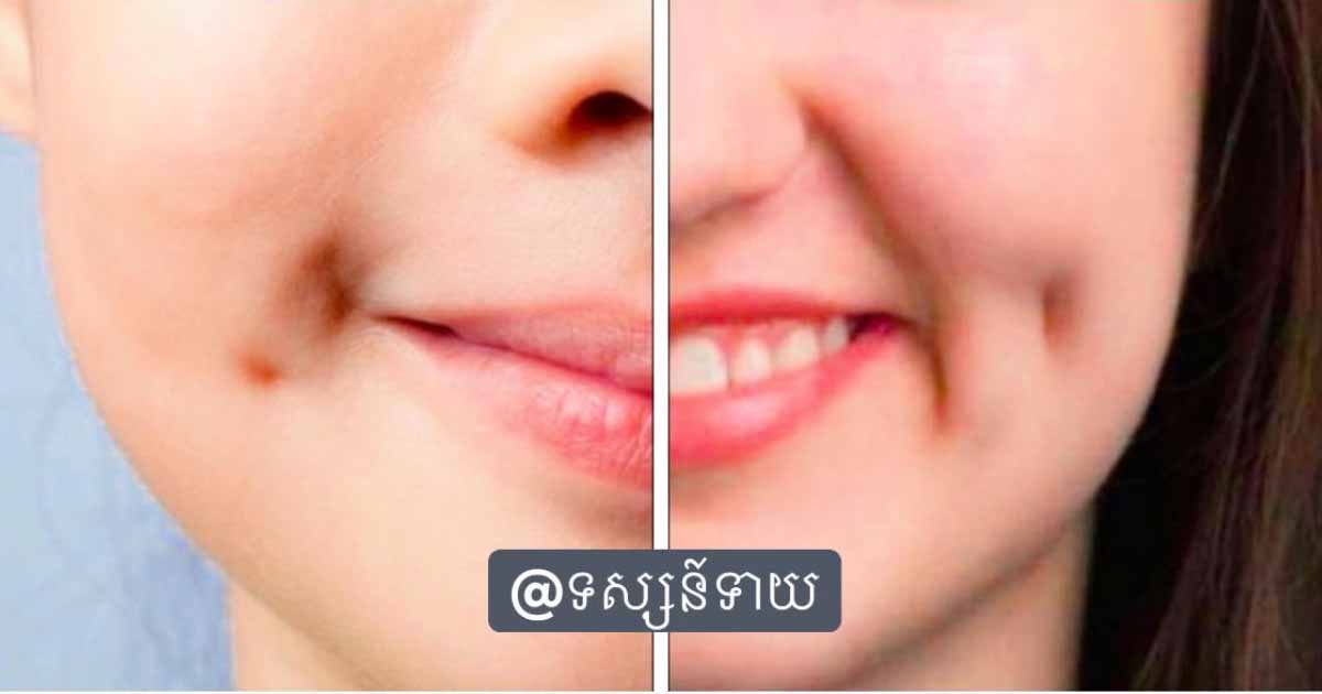 ៣