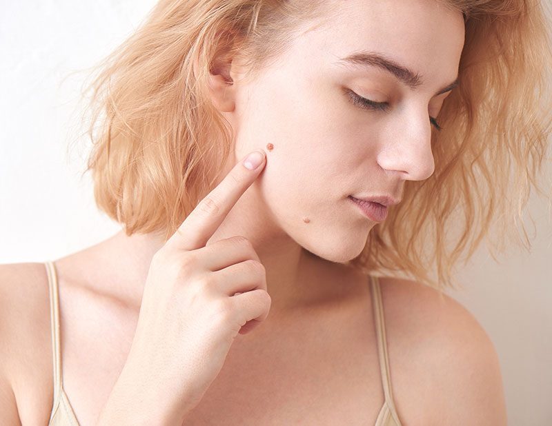 Woman Mole Face