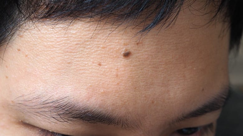 Black,Moles,And,Skin,Texture,With,Acne,On,Asian,Male
