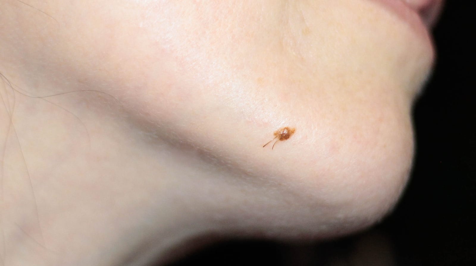 Mole,On,The,Face,On,The,Chin,With,Hair,Growing